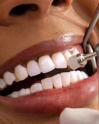 Close up of a smile during a dental treatment